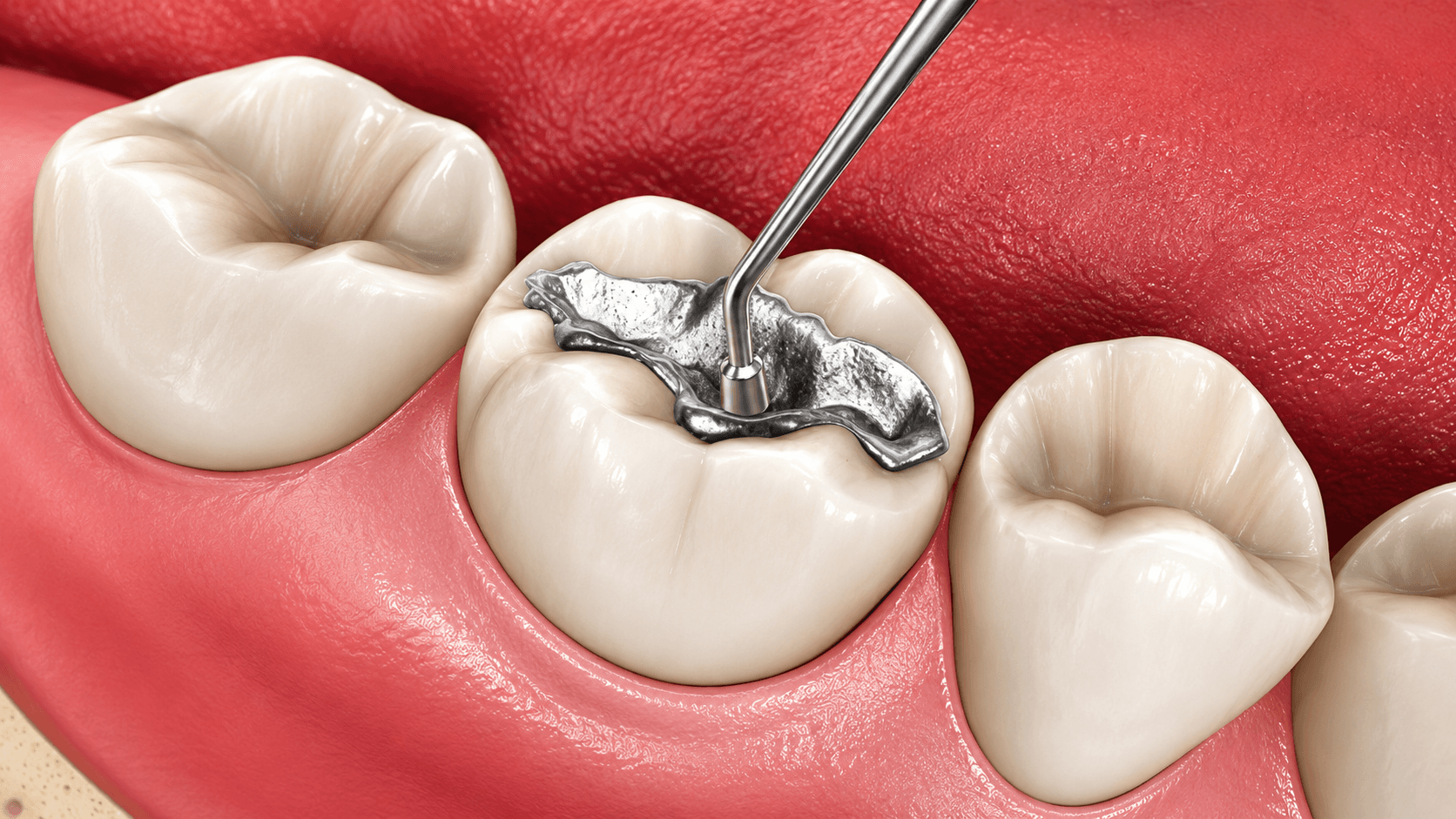 Clinical dental team preparing for a safe amalgam removal procedure