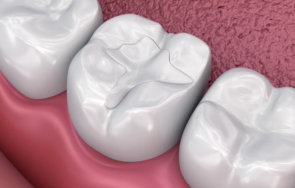 Close-up of natural, healthy white teeth — the goal of composite restoration
