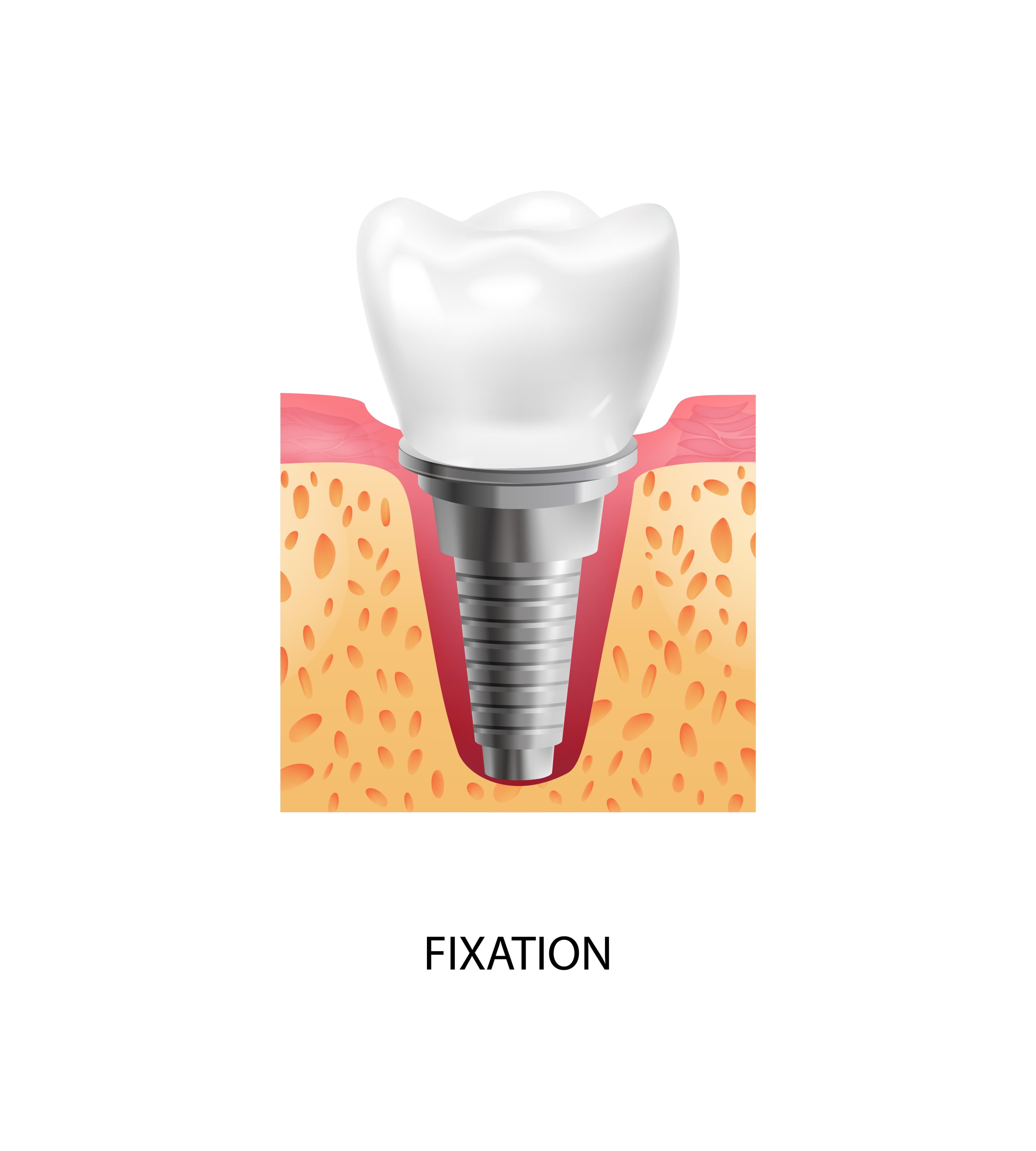 3D illustration of a dental implant integrated into jawbone — Tooth replacement designed to replace both the visible tooth and its natural root
