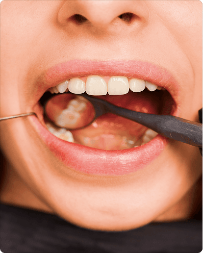 Dental sealants