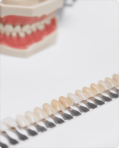 Porcelain inlays and onlays