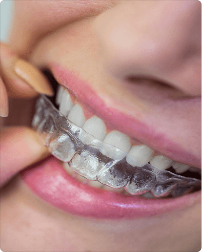 Clear aligners and orthodontic care
