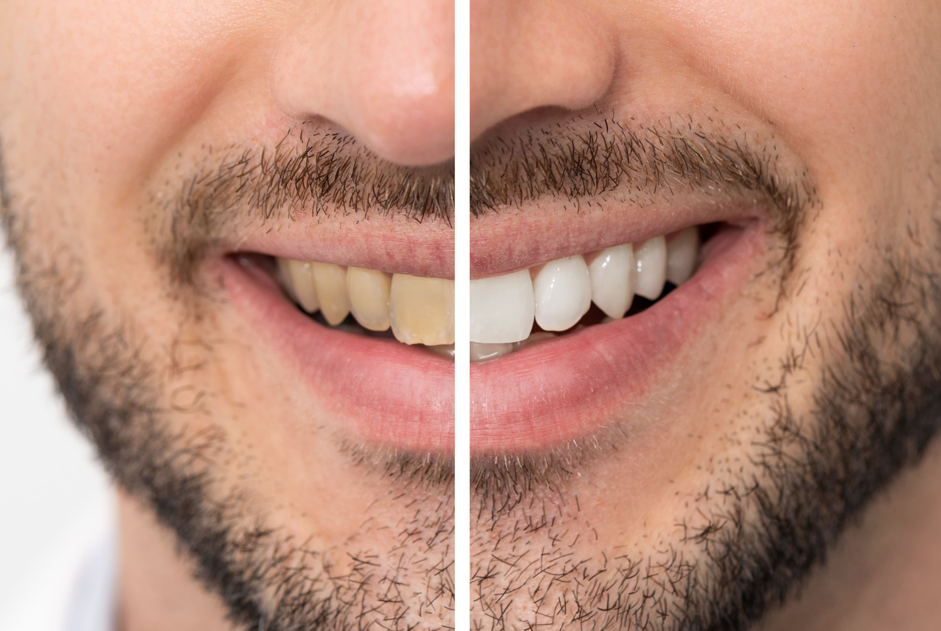 How Much is Teeth Whitening in Ontario?
