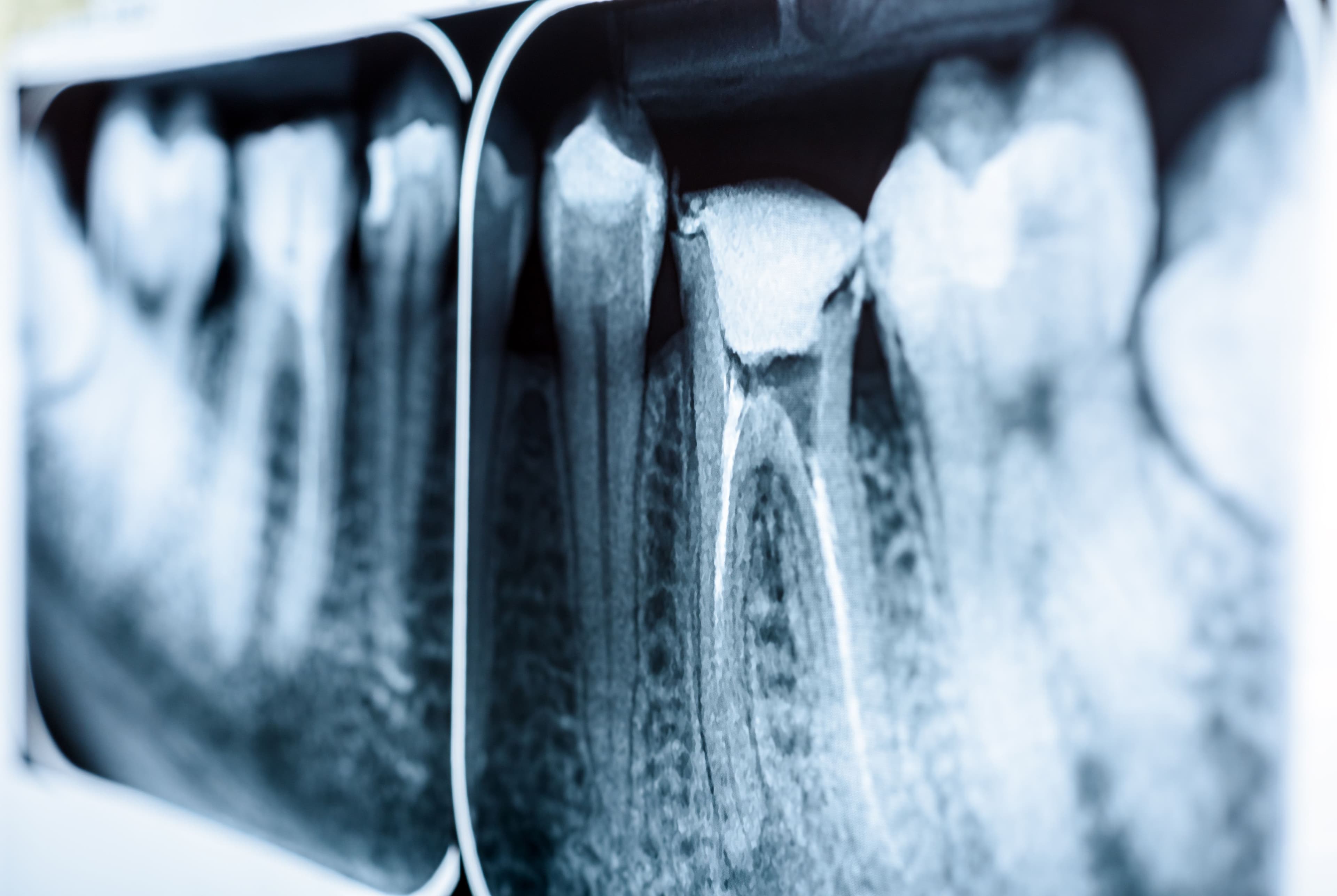 Can You See a Failed Root Canal on an X-Ray? Key Signs Explained
