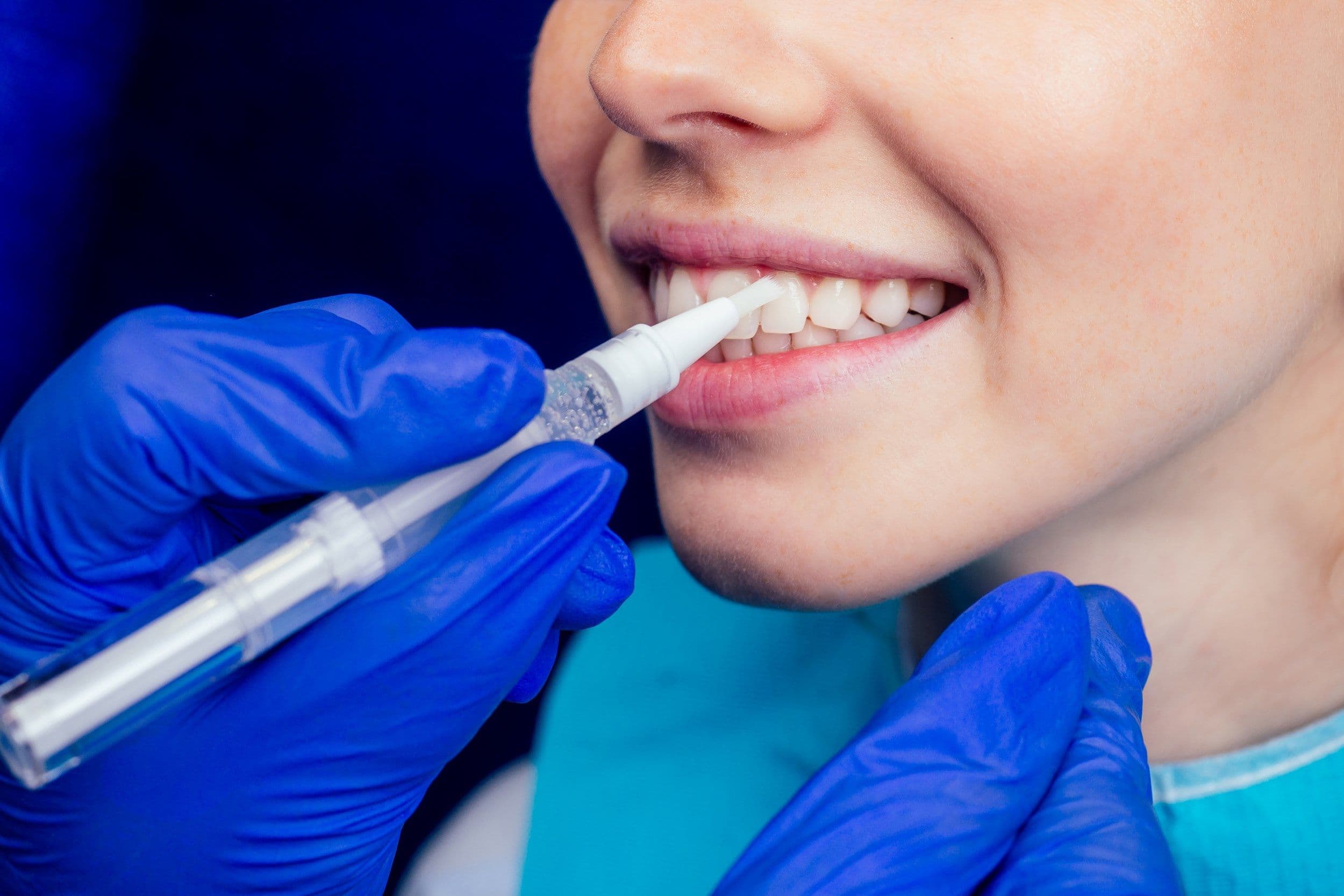 How Long Do Dental Crowns Last? A Complete Guide