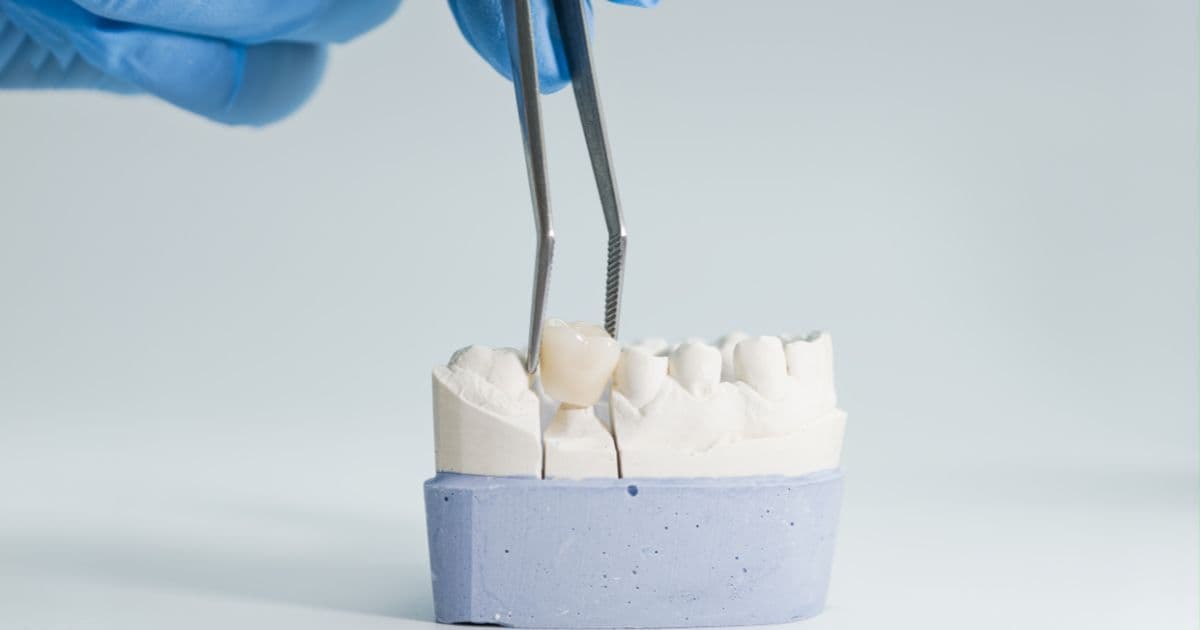 Dental Crowns Before and After: What to Expect