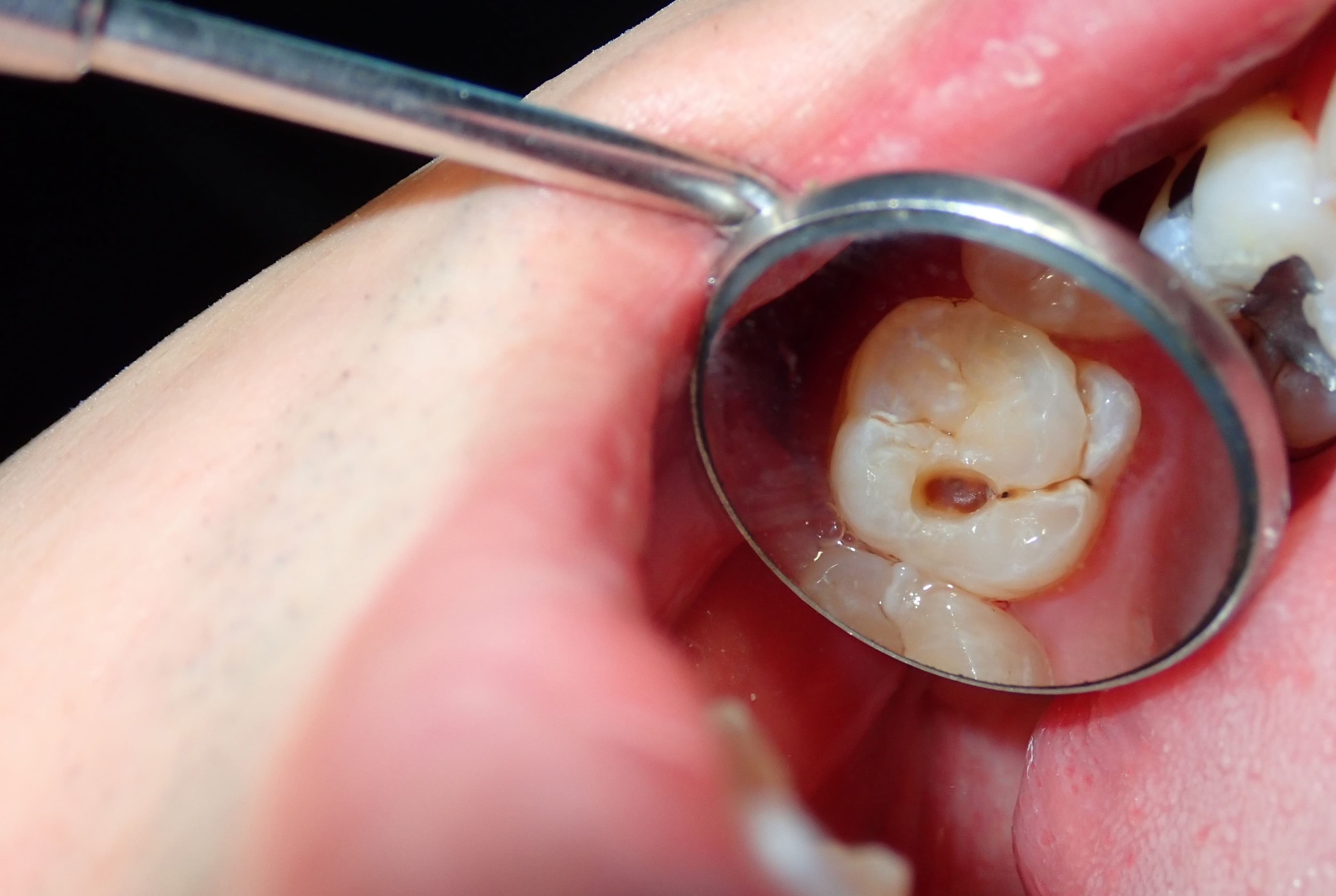 Are Cavities Contagious? What Science Says (Updated 2025)
