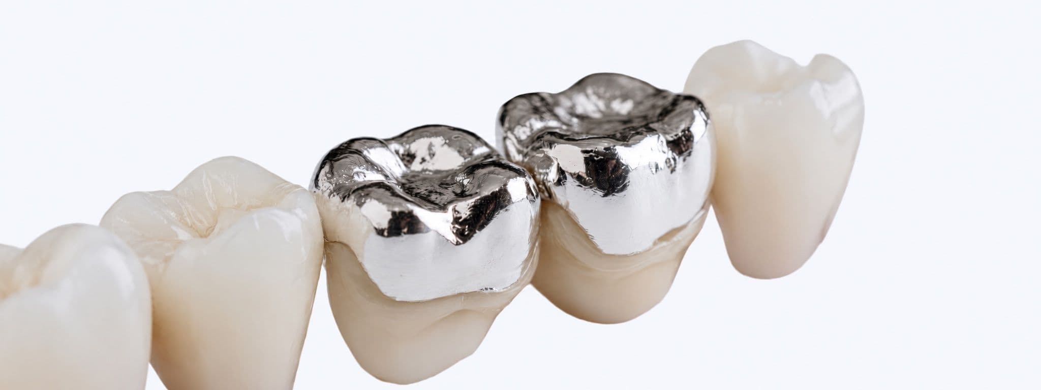 Close-up of dental molars with shiny silver amalgam fillings, surrounded by natural white teeth against a clean white background.