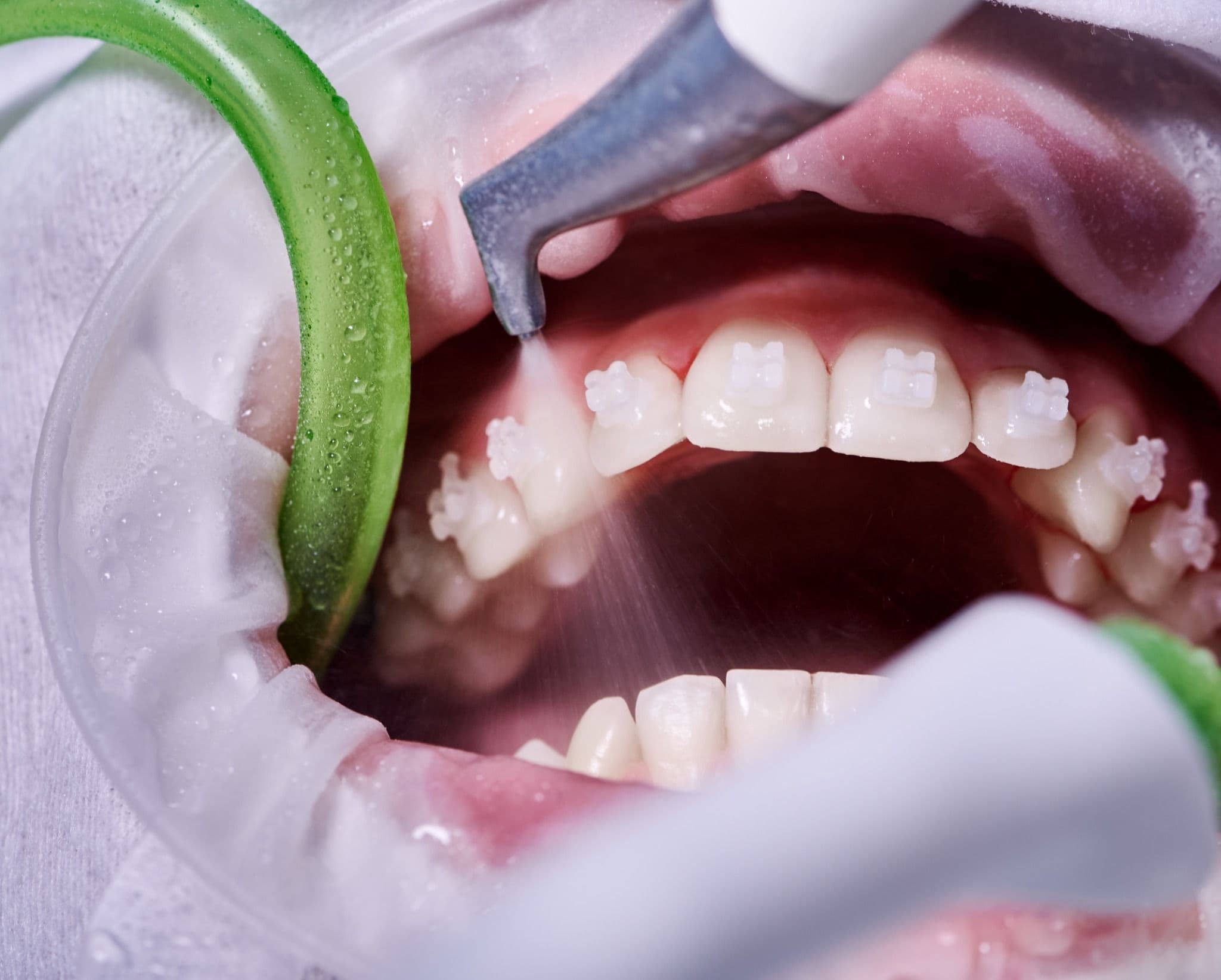 Teeth Cleaning vs Whitening: How to Choose the Right Option