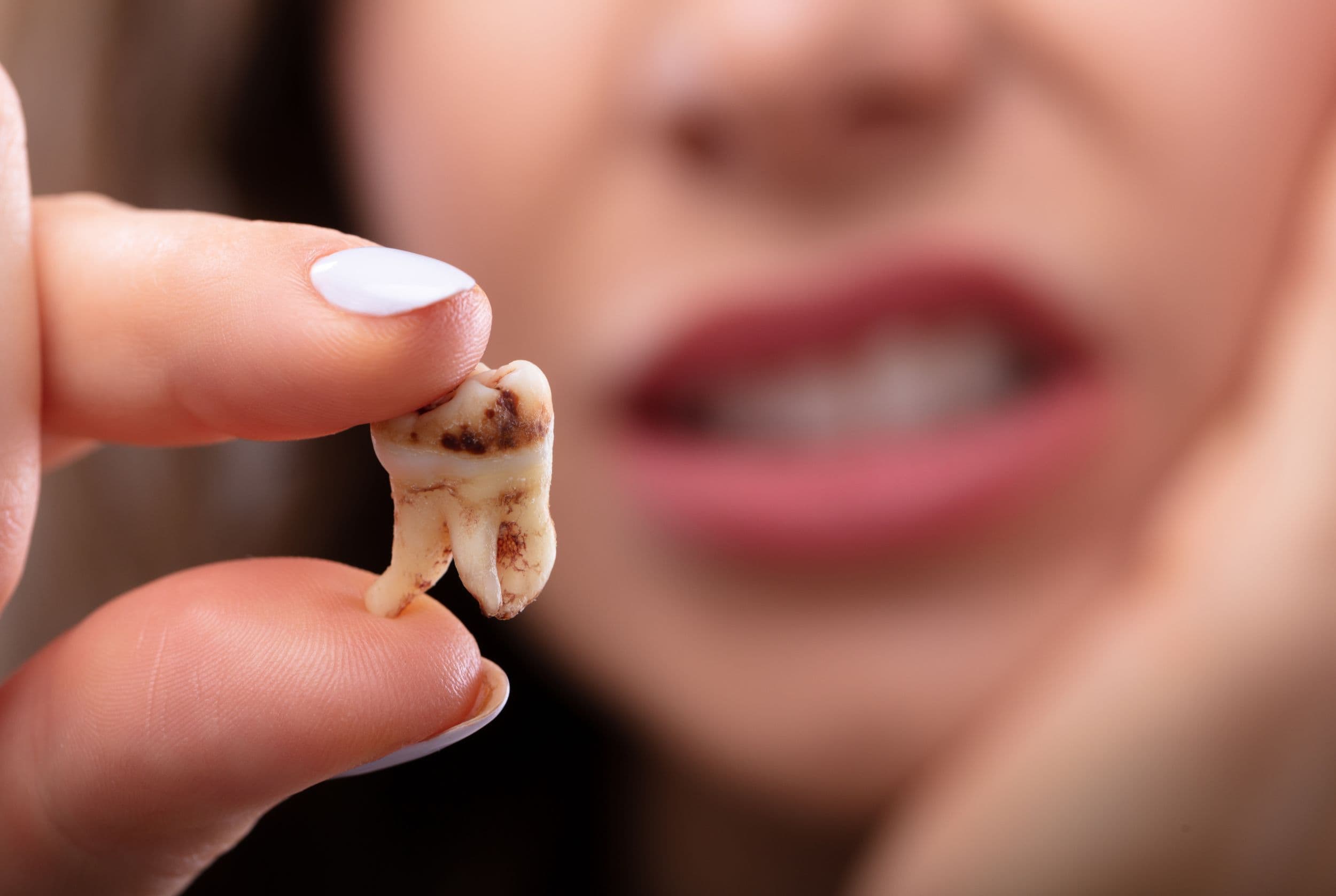 How much is Wisdom Teeth Removal in Ontario?