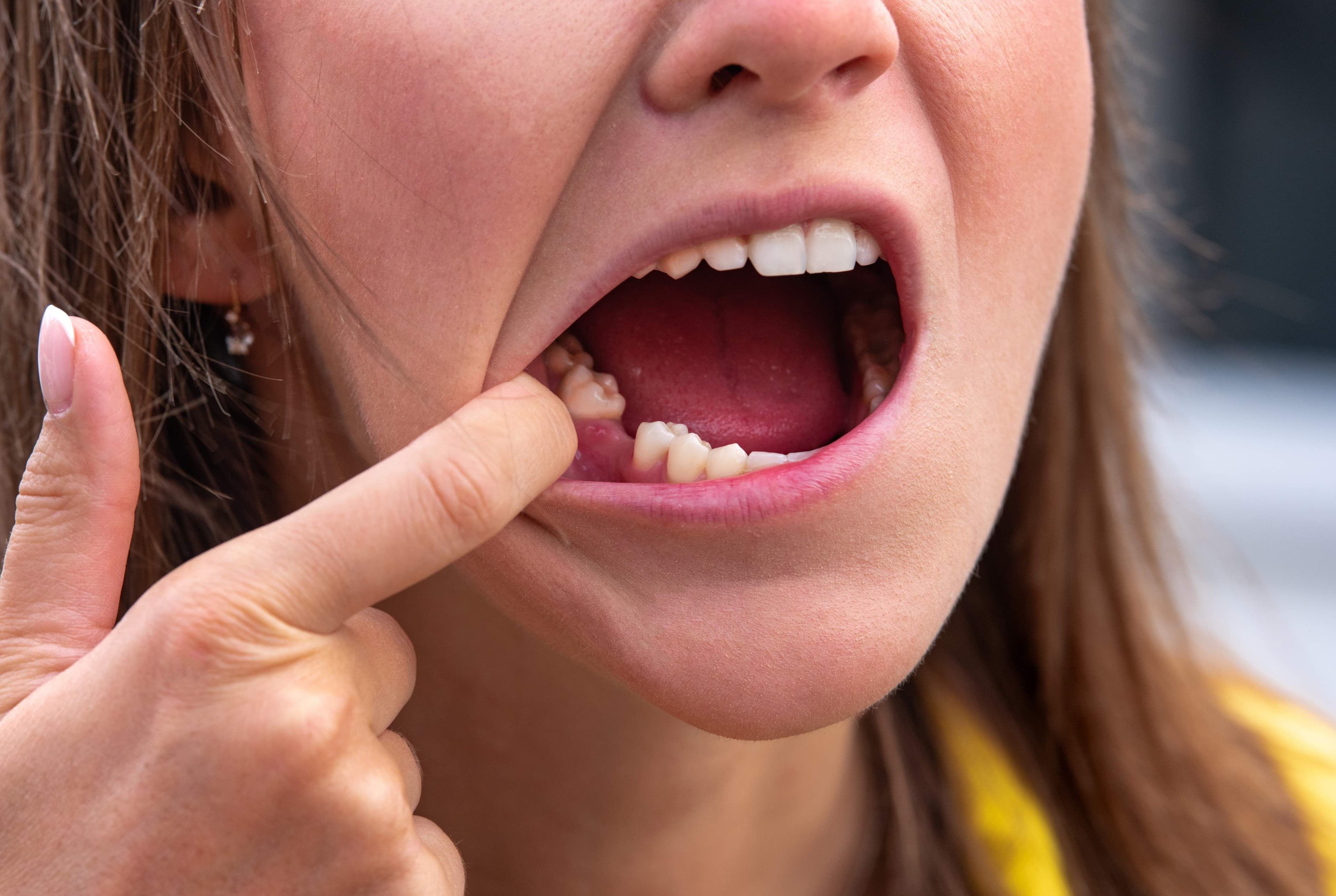 Are Cavities Genetic? All You Need to Know