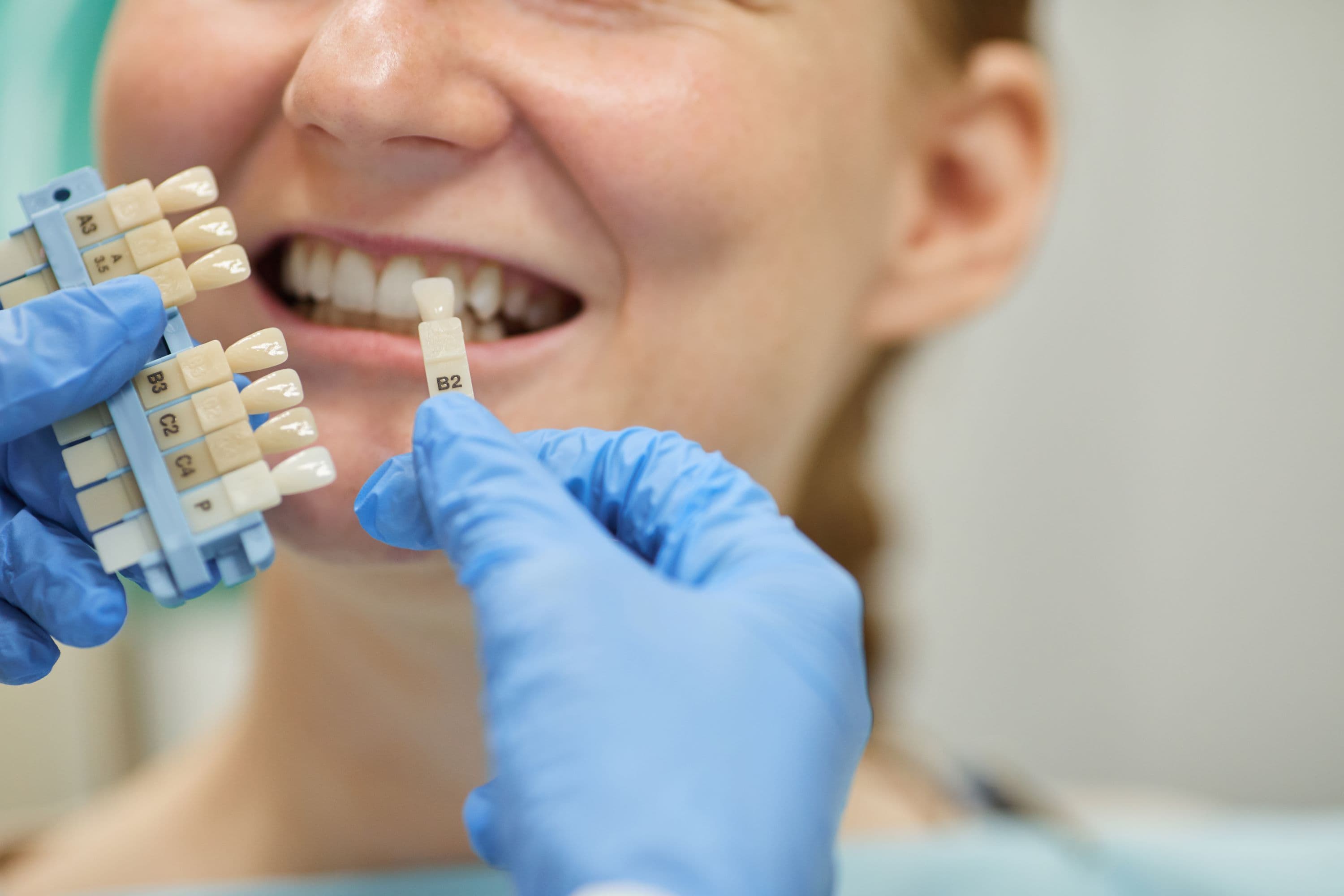 Composite Veneers vs Dental Implants: Which one is best for you?