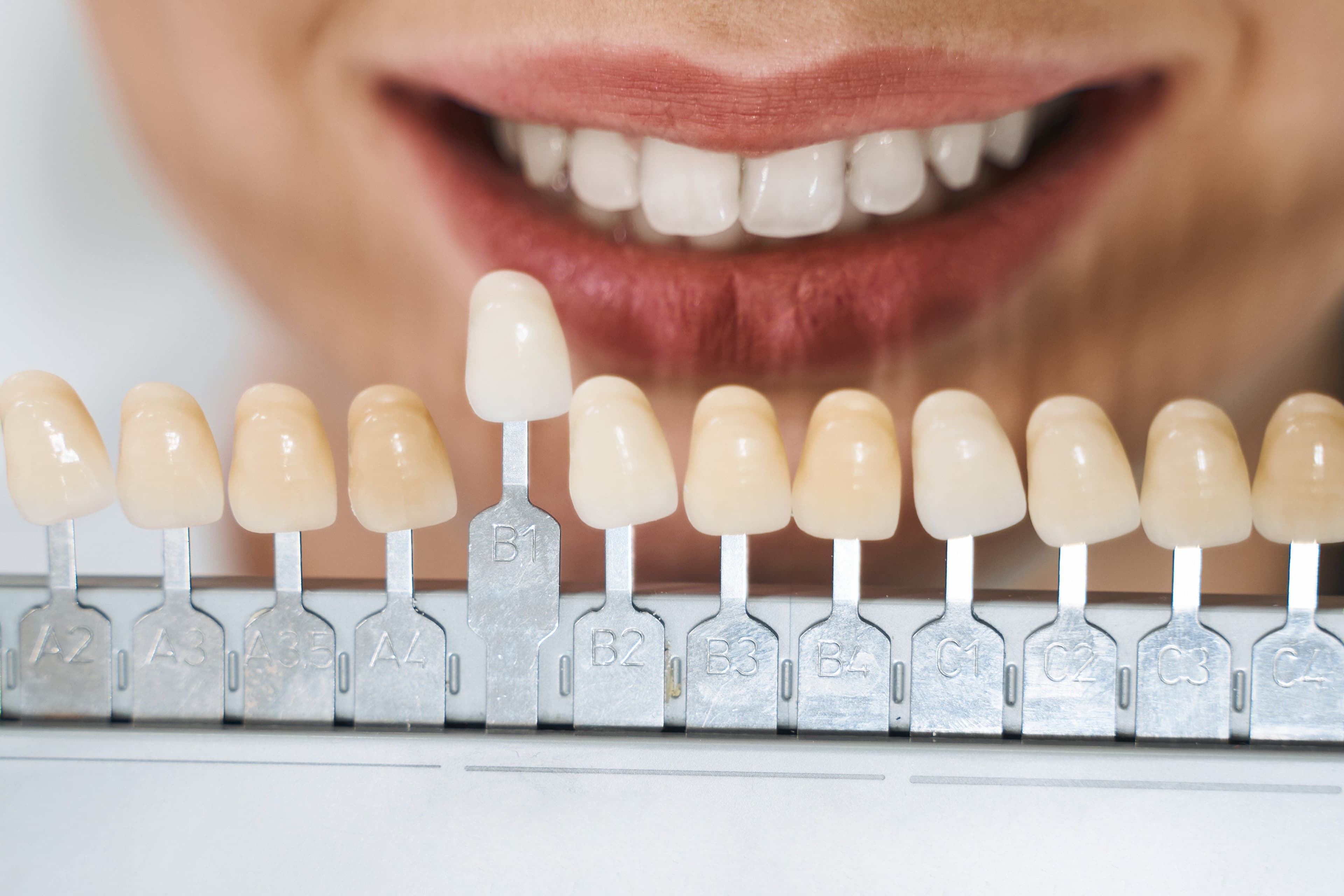 Teeth Bonding vs Veneers: The differences