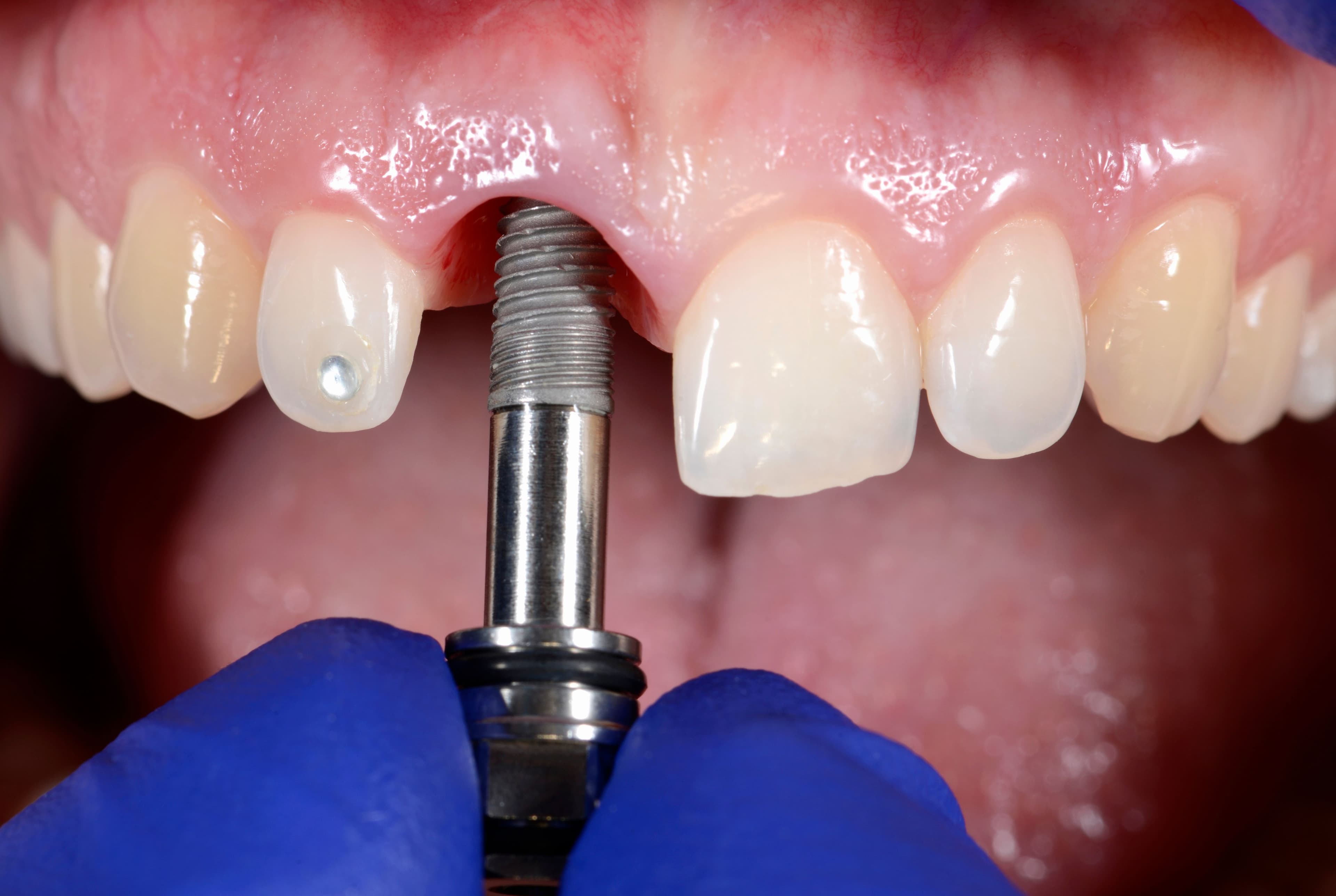 How Much Are Dental Implants in Ontario (Updated 2025)